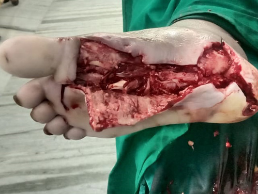Diabetic Foot