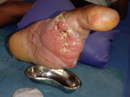 Diabetic Foot