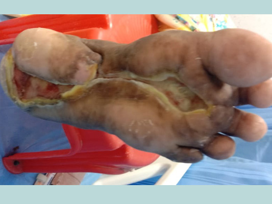 Diabetic Foot