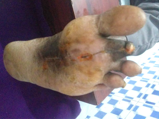 Diabetic Foot